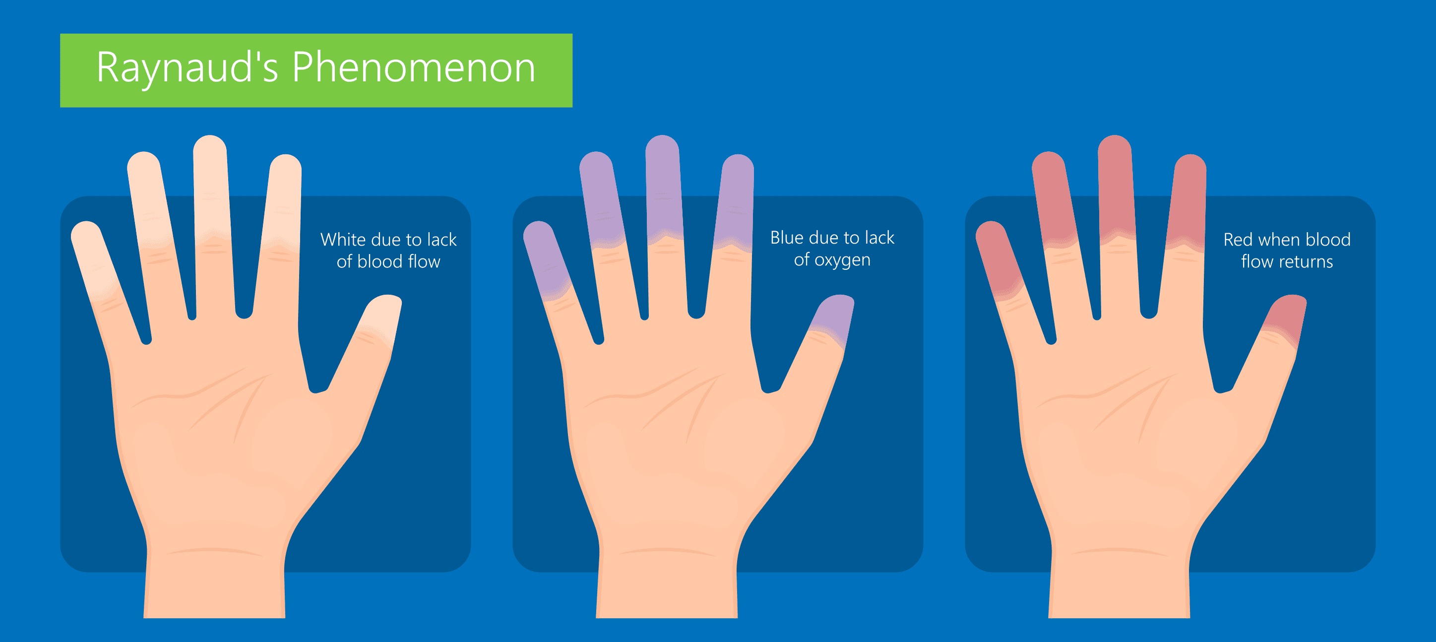 Raynaud’s phenomenon - finger color changes