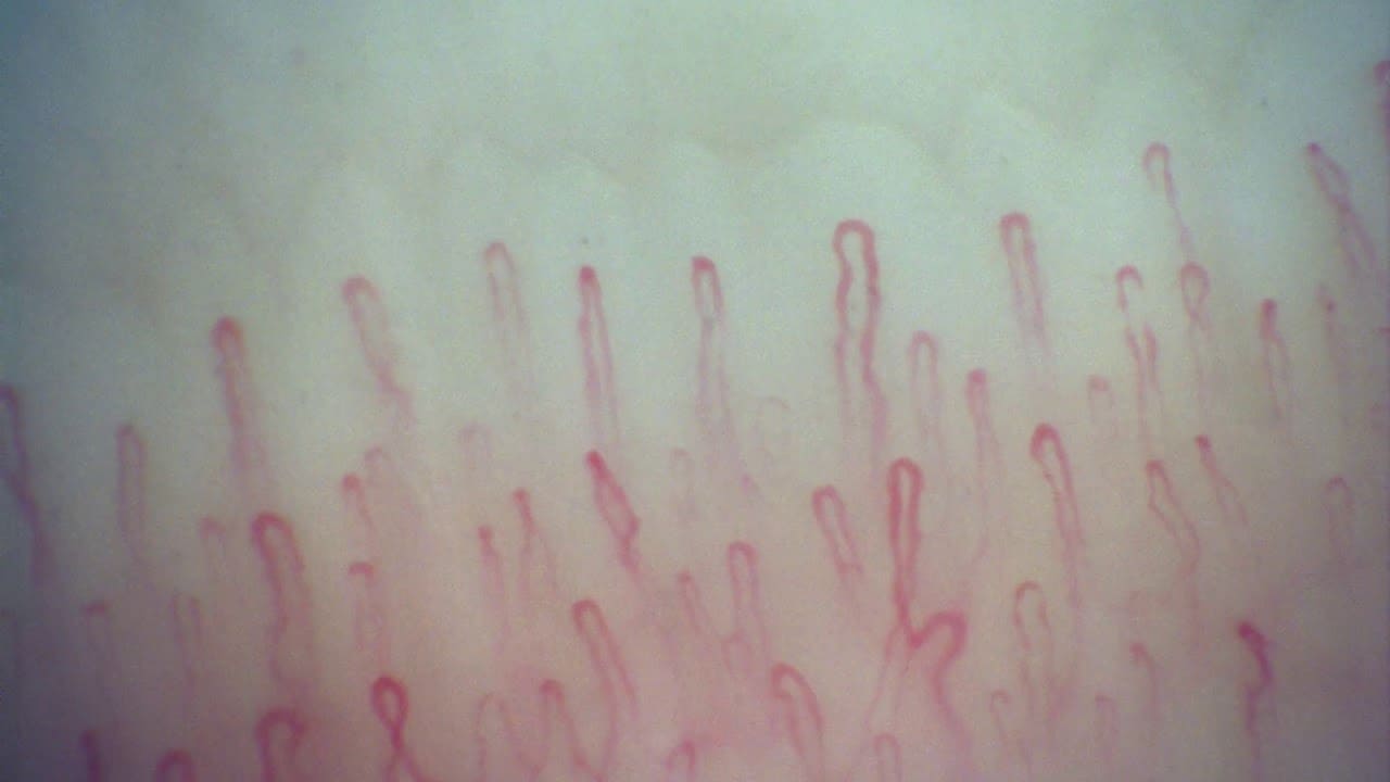 Capillaroscopy example with Inspectis Digital Capillaroscope