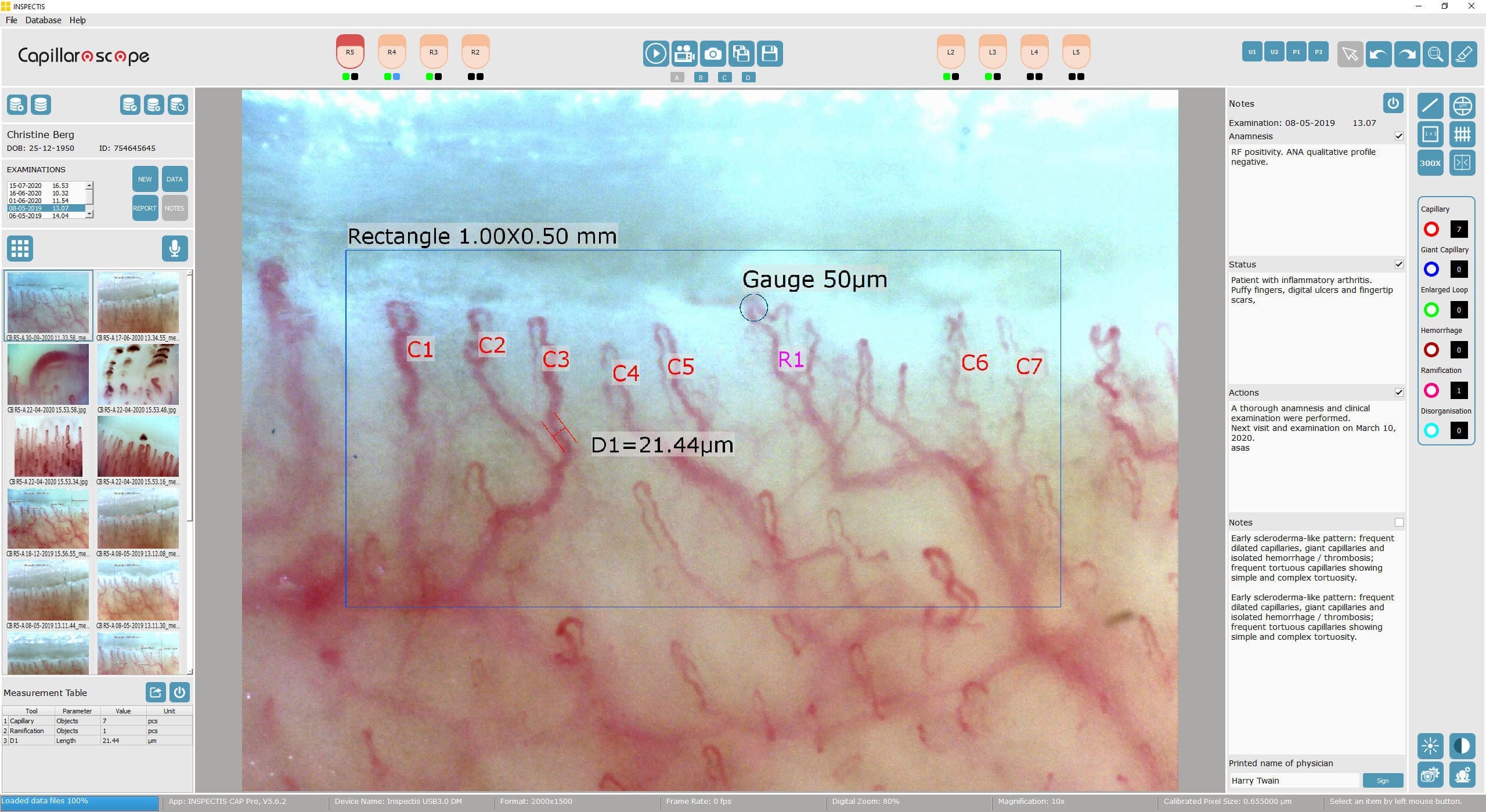 Inspectis Digital Capillaroscope application example