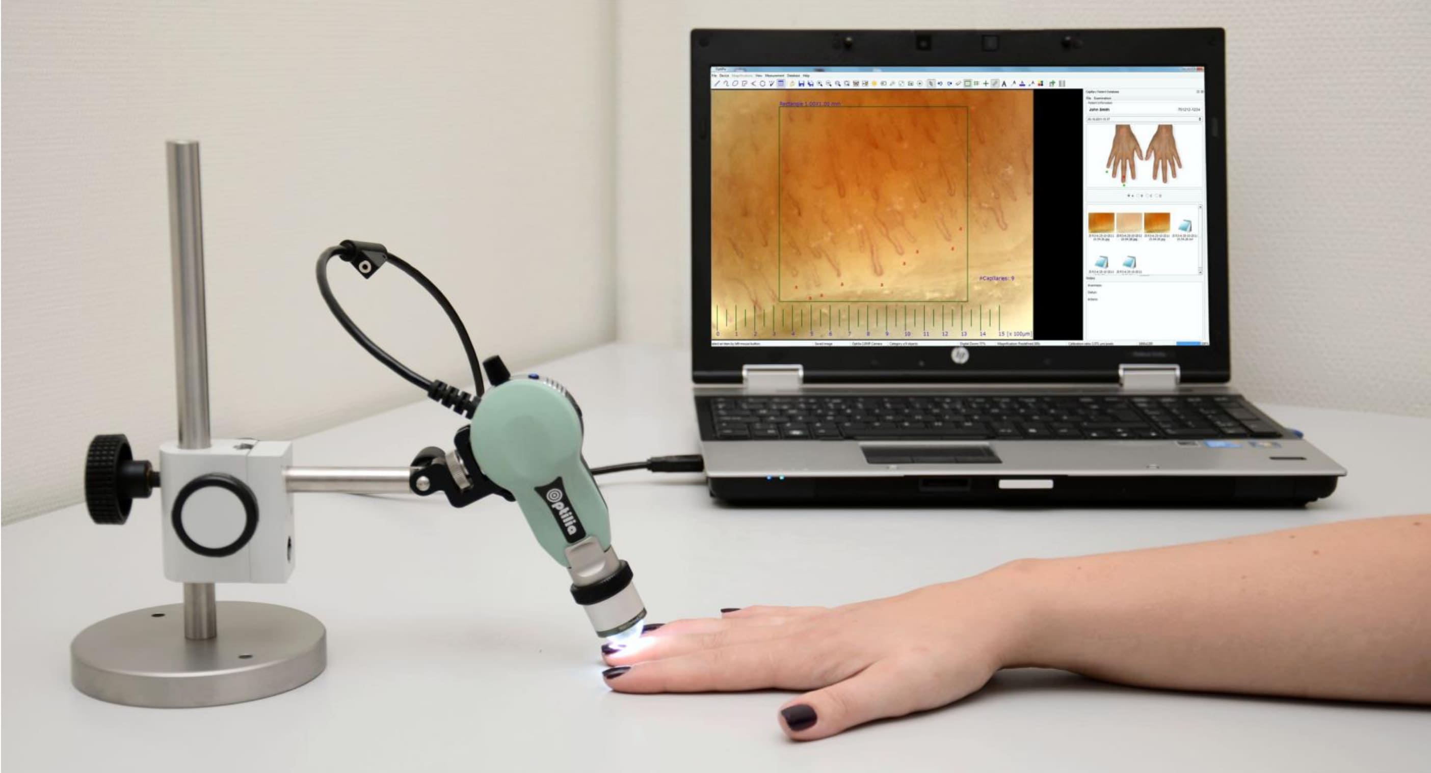 Capillaroscopy procedure - The capillaries at the base of the nails are observed using a portable USB microscope connected to the computer